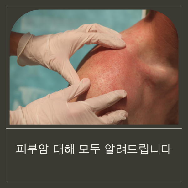 피부암, 원인, 치료 방법, 증상, 진단, 예방, 자외선 차단제