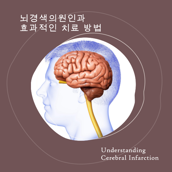 뇌경색, 허혈성 뇌졸중, 뇌혈관, 혈전용해제, 항혈소판제제, 항응고제, 동맥경화증