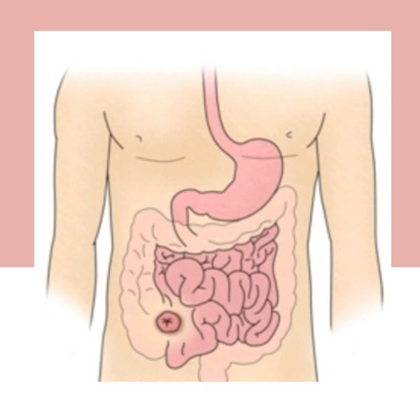 크론병, 염증성 장질환, 소화기관, 만성 염증, 증상, 치료법, 진단, 합병증, 예방, 식습관