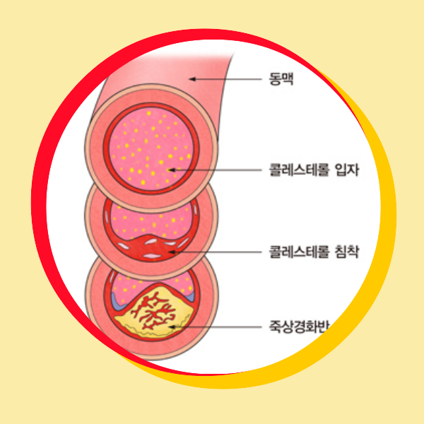 이상지질혈증, 고지혈증, 콜레스테롤, 동맥경화, 심혈관질환