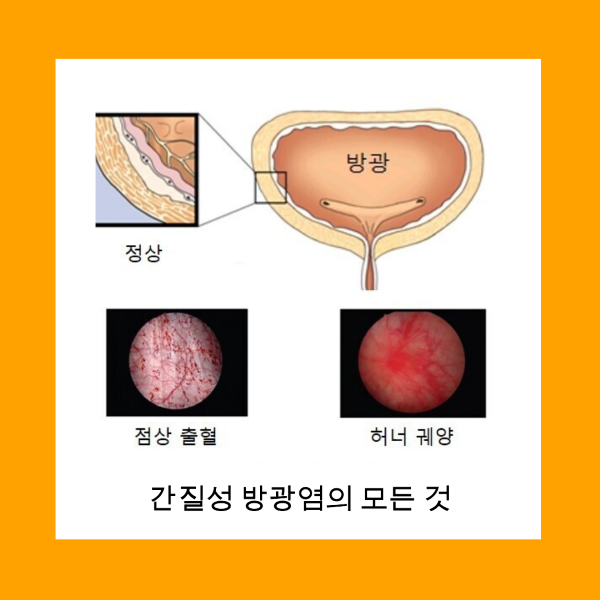 간질성 방광염, 치료, 증상, 소변, 통증, 진단, 원인