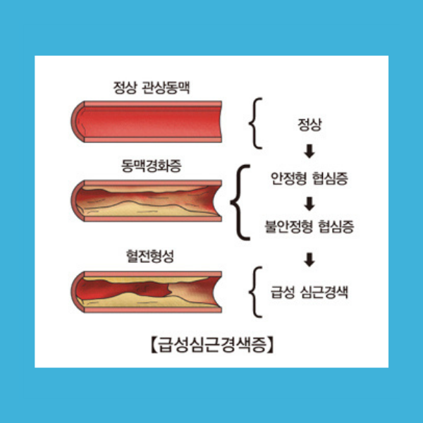 급성 심근경색증, 증상, 진단, 치료, 예방, 돌연사 위험, 건강 검진, 생활습관 개선, 비즈니스 영향, 위험 인자 관리