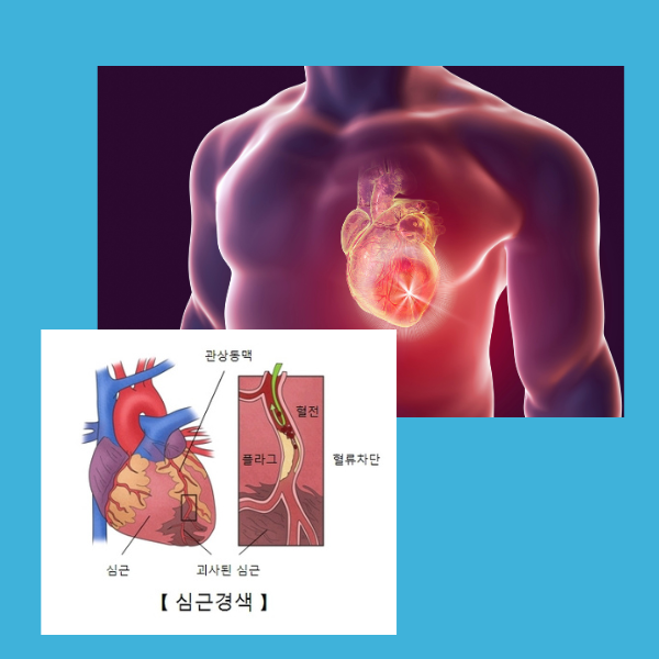 급성 심근경색증, 증상, 진단, 치료, 예방, 돌연사 위험, 건강 검진, 생활습관 개선, 비즈니스 영향, 위험 인자 관리