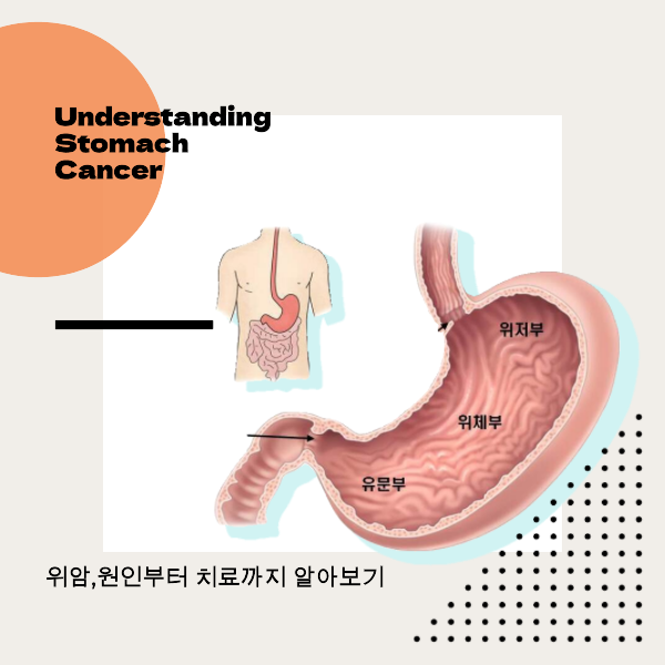 위암, 위암 원인, 위암 치료, 위암 예방, 위암 증상, 위암 진단