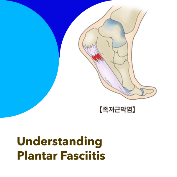 족저근막염, 발꿈치 통증, 발건강, 스트레칭, 치료 방법