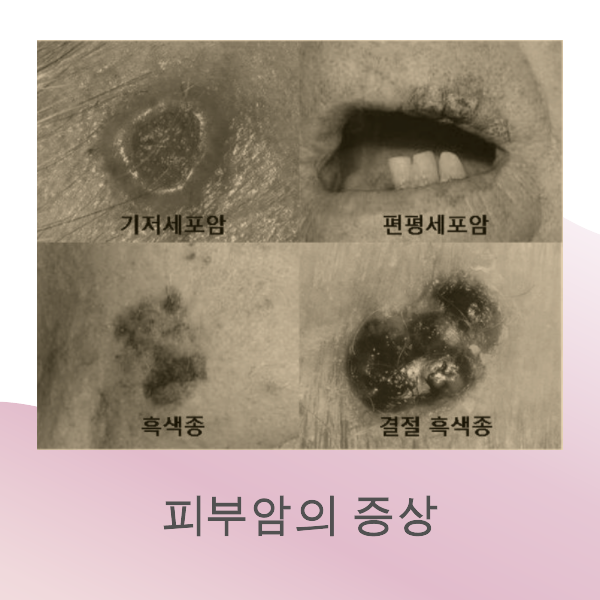 피부암, 원인, 치료 방법, 증상, 진단, 예방, 자외선 차단제