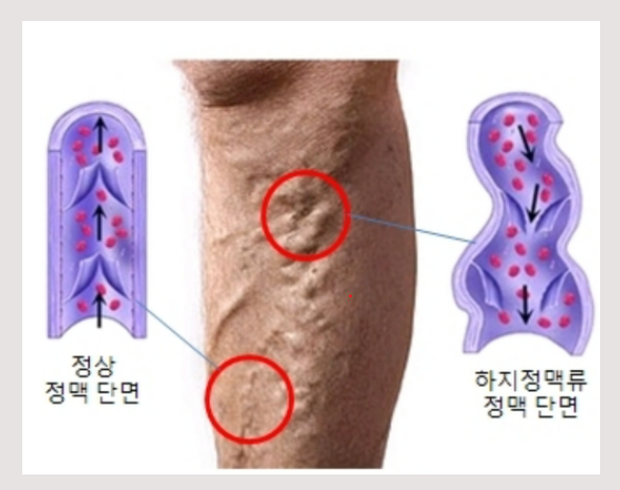 하지정맥류, 증상, 진단, 치료방법, 원인, 포도당류환자, 관절부전, 경련치료, 괄약근