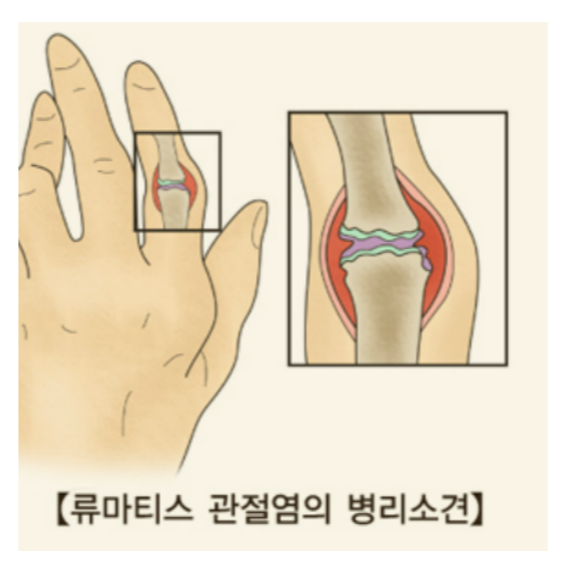 류마티스관절염, 관절염치료제, 증상, 원인, 진단, 예방