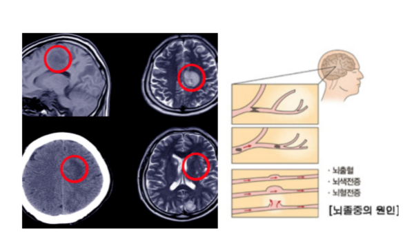뇌졸증의 원인
